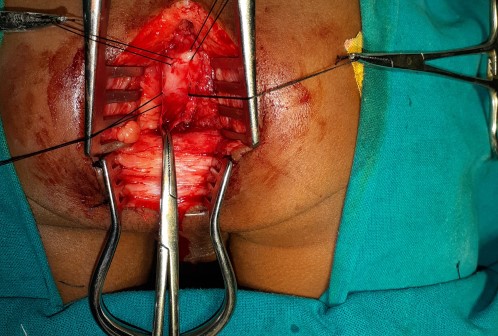 Anorectal Surgery in Shri Vatsalya Hospital