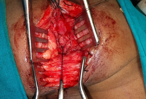 Anorectal Surgery in Shri Vatsalya Hospital