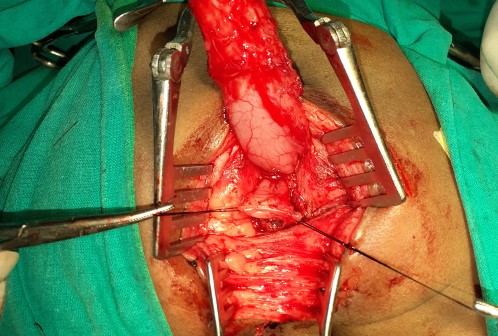 Anorectal Surgery in Shri Vatsalya Hospital