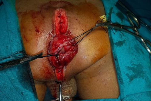 Anorectal Surgery in Shri Vatsalya Hospital