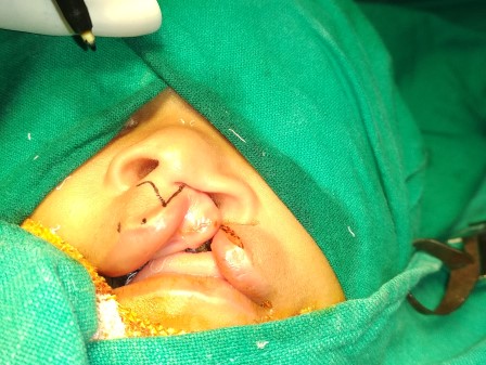 cleft Lip Surgery in Shri Vatsalya Hospital