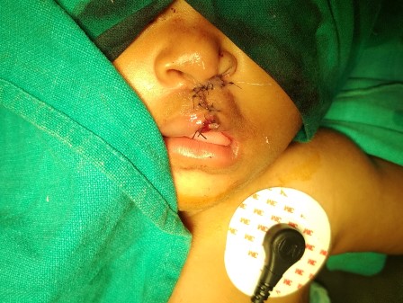 cleft Lip Surgery in Shri Vatsalya Hospital