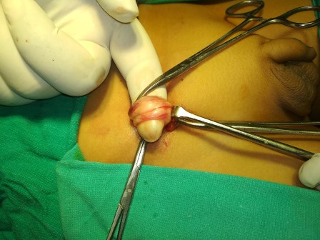 Hernia Surgery in Shri Vatsalya Hospital