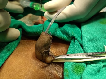 Hypospadias Surgery in Shri Vatsalya Hospital