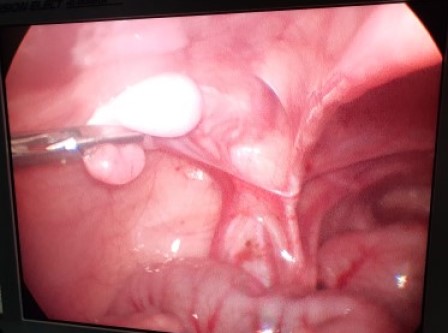 Laparoscopicpyeloplasty Surgery in Shri Vatsalya Hospital