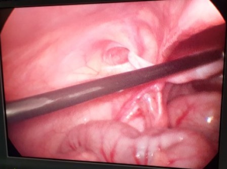 Laparoscopicpyeloplasty Surgery in Shri Vatsalya Hospital