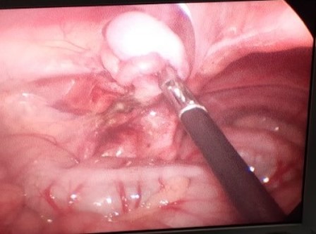 Laparoscopicpyeloplasty Surgery in Shri Vatsalya Hospital