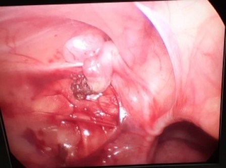 Laparoscopicpyeloplasty Surgery in Shri Vatsalya Hospital