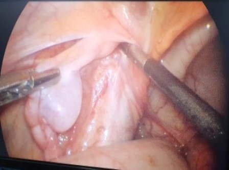 Laparoscopicpyeloplasty Surgery in Shri Vatsalya Hospital