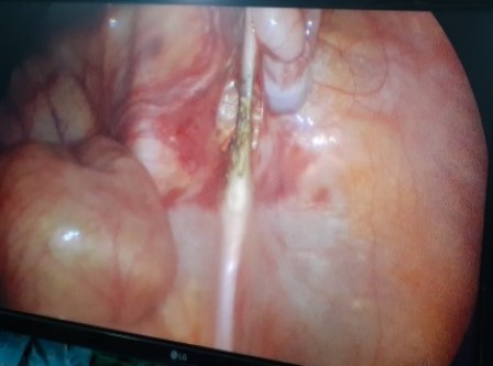 Laparoscopicpyeloplasty Surgery in Shri Vatsalya Hospital