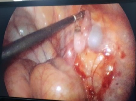 Laparoscopicpyeloplasty Surgery in Shri Vatsalya Hospital