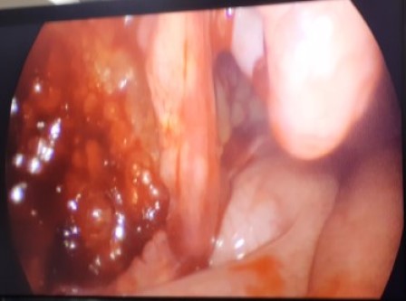 Laparoscopicpyeloplasty Surgery in Shri Vatsalya Hospital