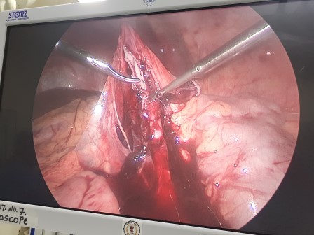 Laporchidopexy Surgery in Shri Vatsalya Hospital