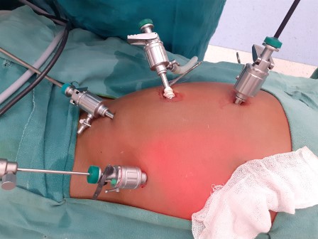 Laporchidopexy Surgery in Shri Vatsalya Hospital