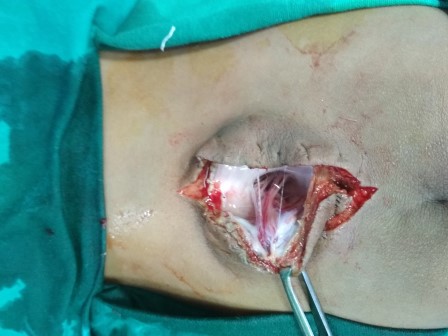 Meningomyelocele Surgery in Shri Vatsalya Hospital