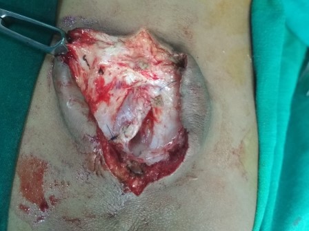 Meningomyelocele Surgery in Shri Vatsalya Hospital