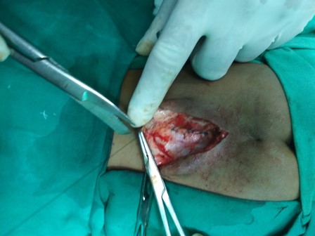 Meningomyelocele Surgery in Shri Vatsalya Hospital