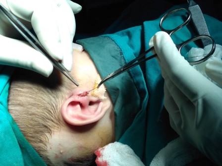 Preauricularsinus Surgery in Shri Vatsalya Hospital