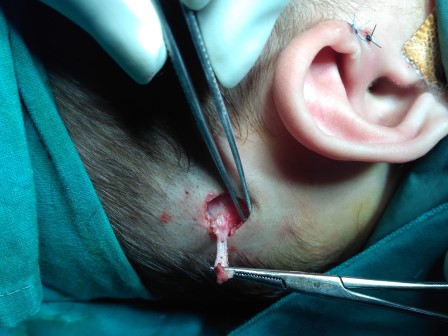 Preauricularsinus Surgery in Shri Vatsalya Hospital