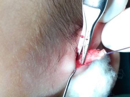 Preauricularsinus Surgery in Shri Vatsalya Hospital