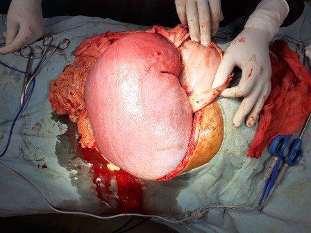 Spleenectomy Surgery in Shri Vatsalya Hospital