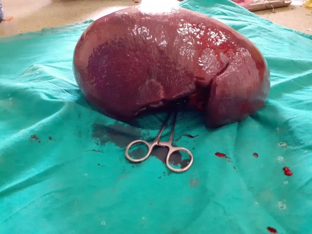 Spleenectomy Surgery in Shri Vatsalya Hospital